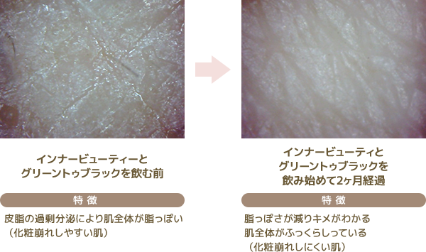 30代女性 脂性肌タイプ